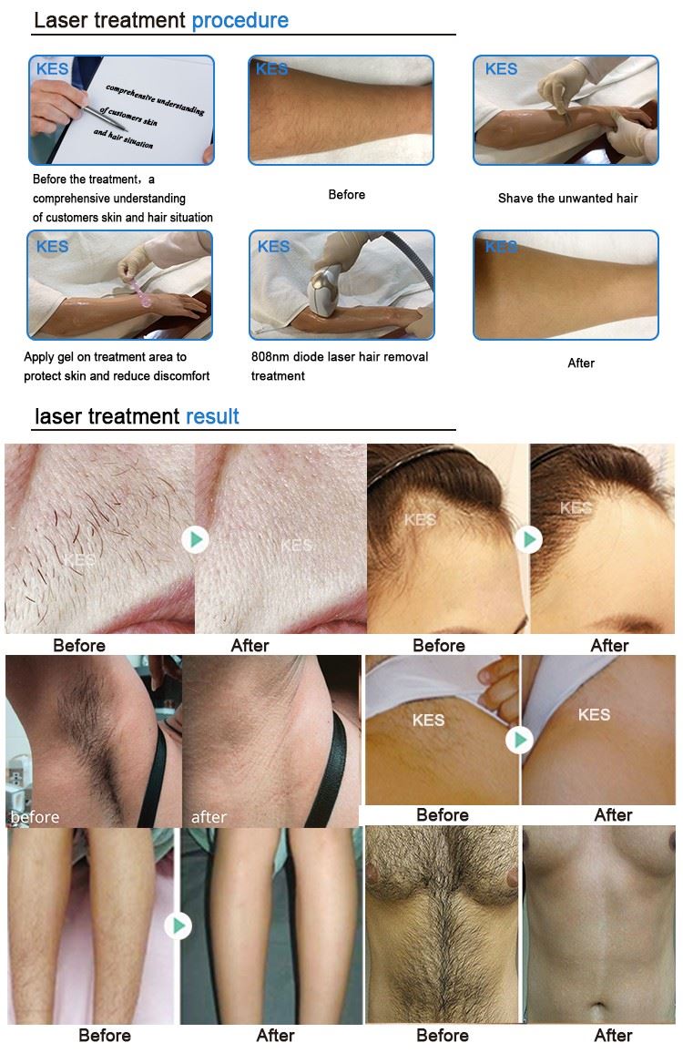 diode laser (2)