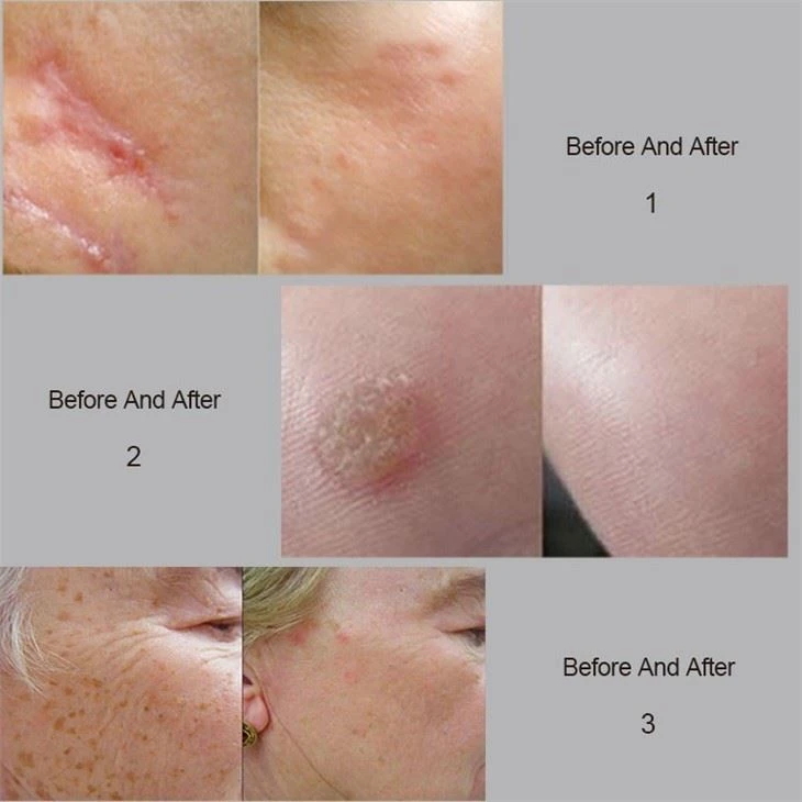 Best Fractional + UltraPulse + Gynae (Optional) CO2 Laser Machine