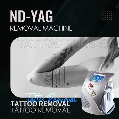 ND: YAG lézer 1064NM tetoválás eltávolító gép